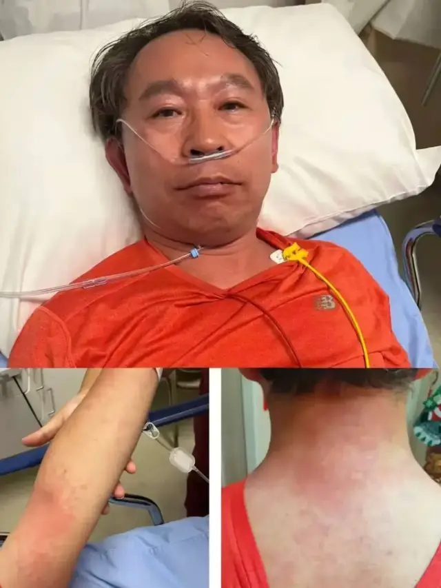 △病情稍微稳定后,谭先杰让同事拍下了自己的脸色和身上大片的皮疹,此时脸色已经好多了。 △病情稍微稳定后,谭先杰让同事拍下了自己的脸色和身上大片的皮疹,此时脸色已经好多了。