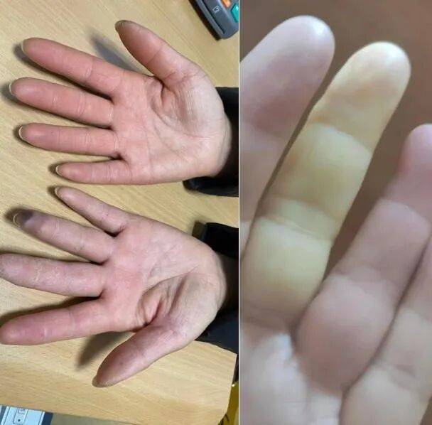 图源：邵逸夫医院风湿免疫科